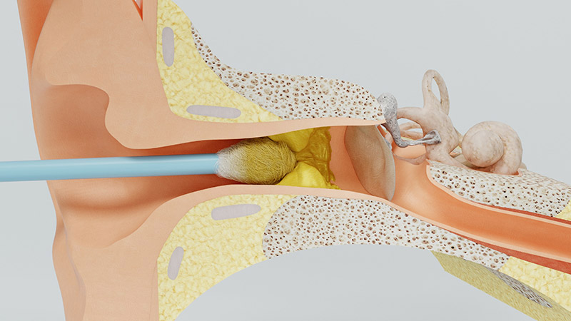 CERUMEN