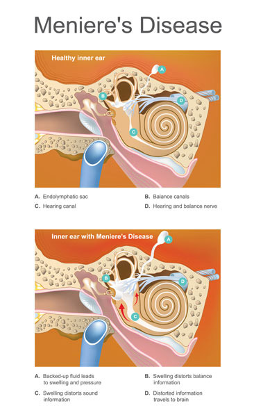 Comprehensive Treatment for Ménière's Disease at Castle Rock Ear Associates in Castle Rock, CO.