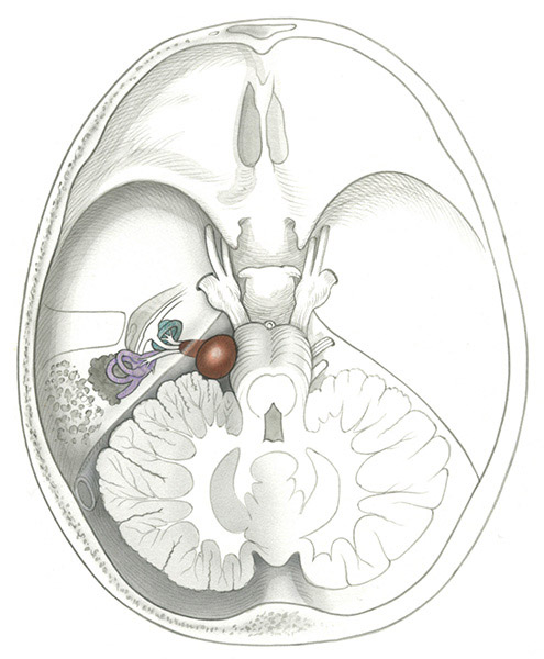 Specialized Care for Acoustic Neuroma at Castle Rock Ear Associates in Castle Rock, CO.