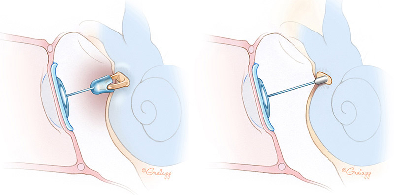 Specialized Diagnosis & Treatment for Otosclerosis at Castle Rock Ear Associates in Castle Rock, CO.
