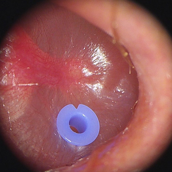 Myringotomy Procedure for Ear Infection by Castle Rock Ear Associates, CO