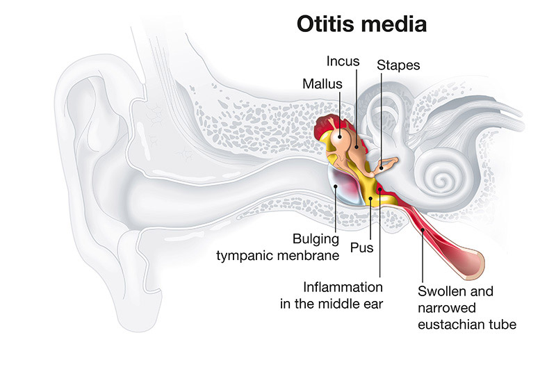 Otitis Media Ear Infection Treatment by Castle Rock Ear Associates, CO