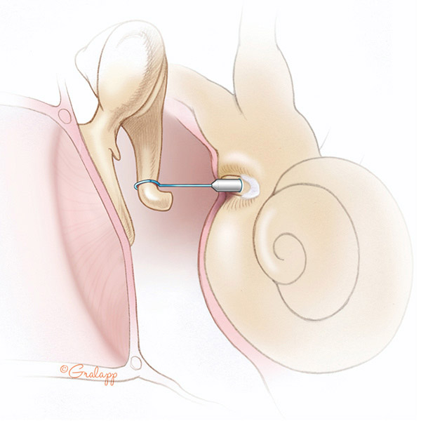 Expert Diagnosis & Treatment for Otosclerosis at Castle Rock Ear Associates in Castle Rock, CO.