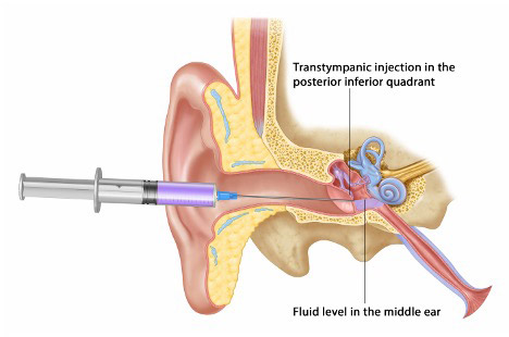 Transtympanic Injection Procedure by Castle Rock Ear Associates, CO