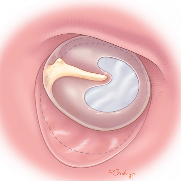 Advanced Tympanoplasty Surgery for Eardrum Repair at Castle Rock Ear Associates in Castle Rock, CO.