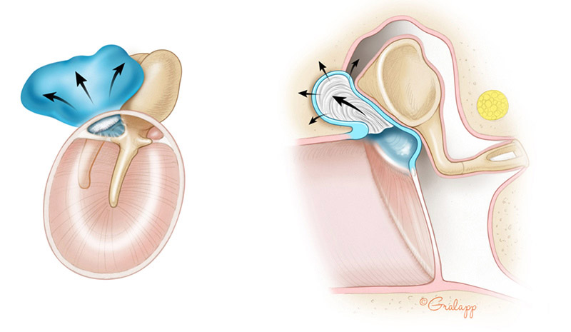 Diagnosis & Surgical Illustration of Cholesteatoma at Castle Rock Ear Associates in Castle Rock, CO