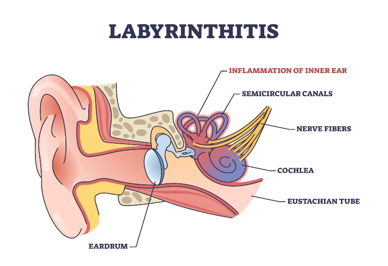 An Infographic Showing the Ear Infection & Medical Inflammation for Labyrinthitis in Castle Rock, CO