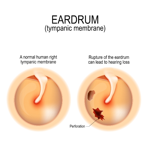 Infographic of a Healthy and Ruptured Tympanic Membrane in Castle Rock, CO